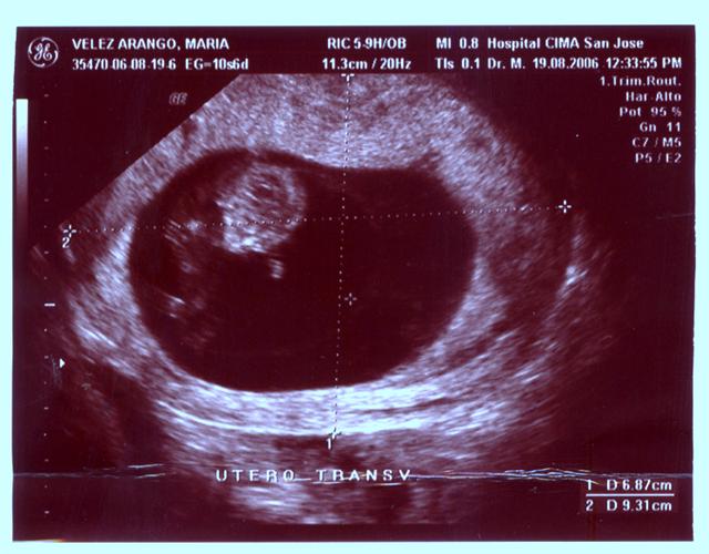 utero transv 2 (Small).jpg